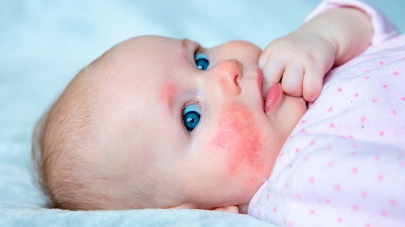 When Formula Causes a Rash: CMPA Guide